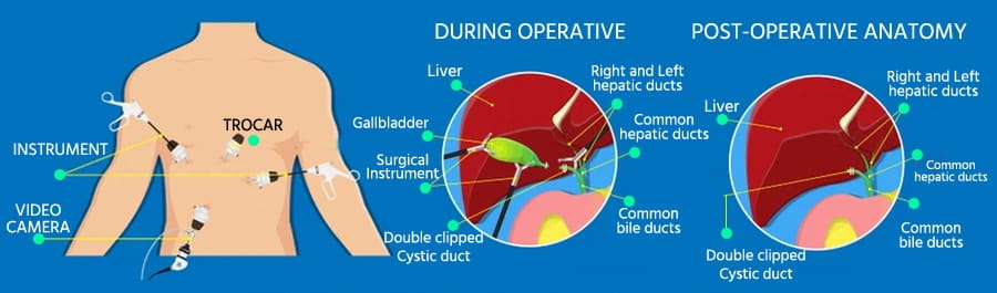 Graphic showing during operative and post-operative anatomy