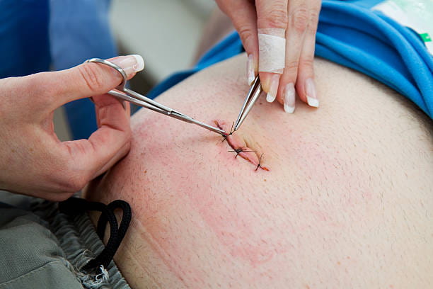 Nurse is removing stitches patient after operation